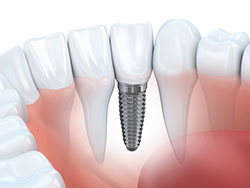 Dental Implants in in Cincinnati, OH